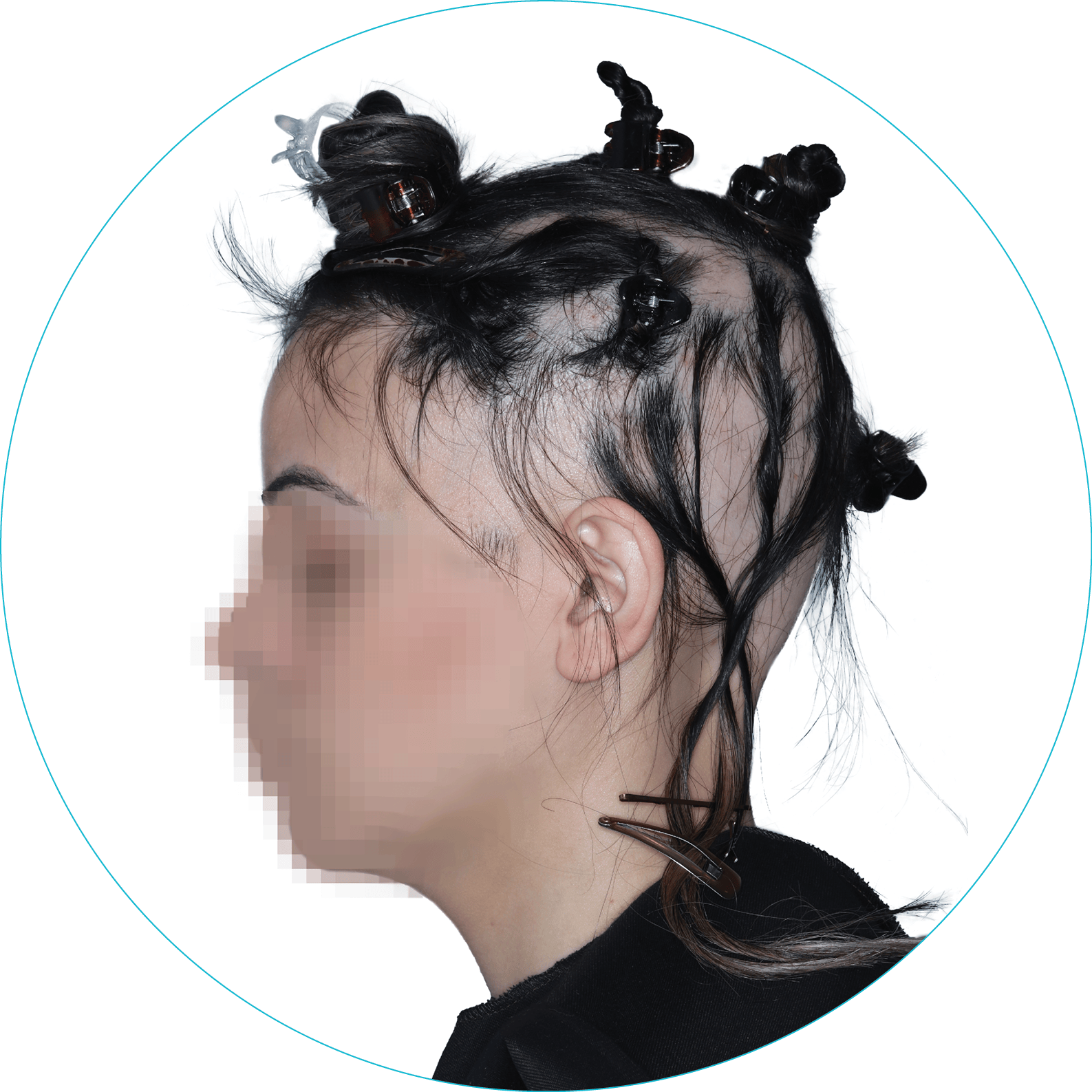 Alopecia Areata patient